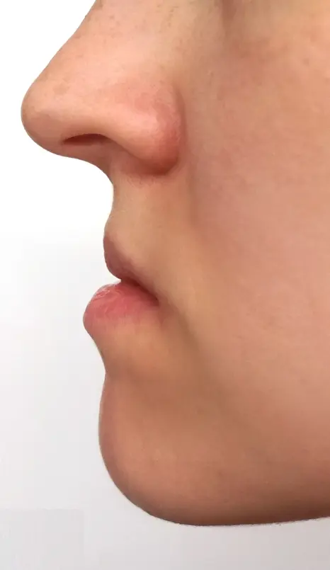 cirurgia-ortognática-antes cirurgia-ortognática-antes