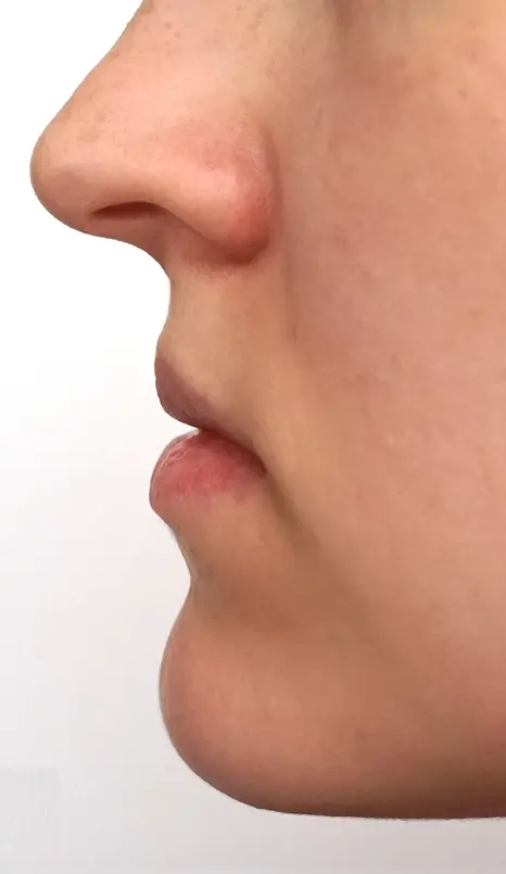 cirurgia-ortognática-depois