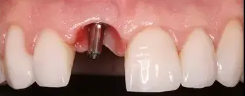 implante-dentario-antes-1 implante-dentario-antes-1