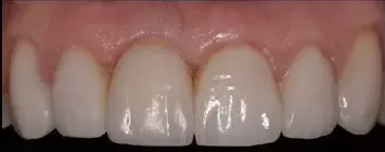 implante-dentario-depois-1