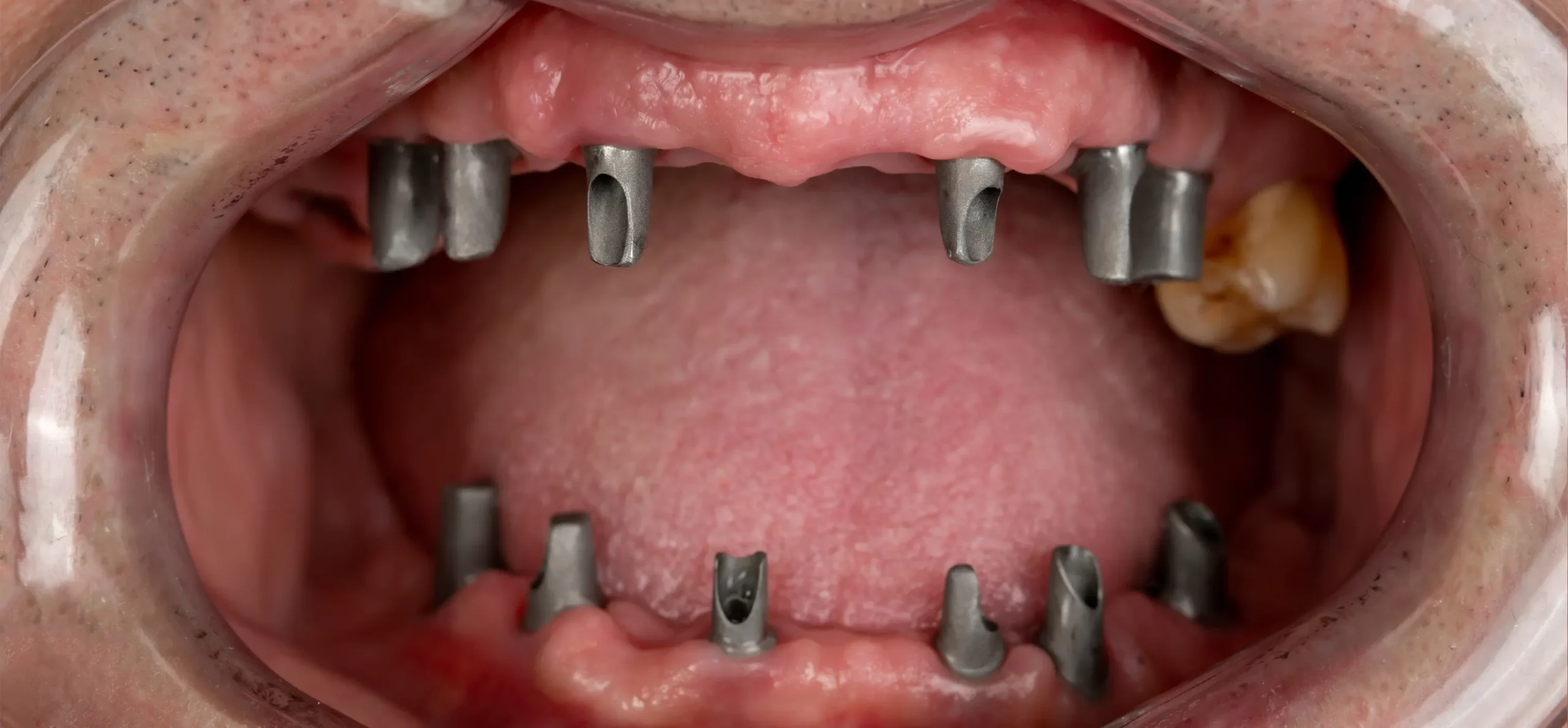 implantodontia-antes implantodontia-antes