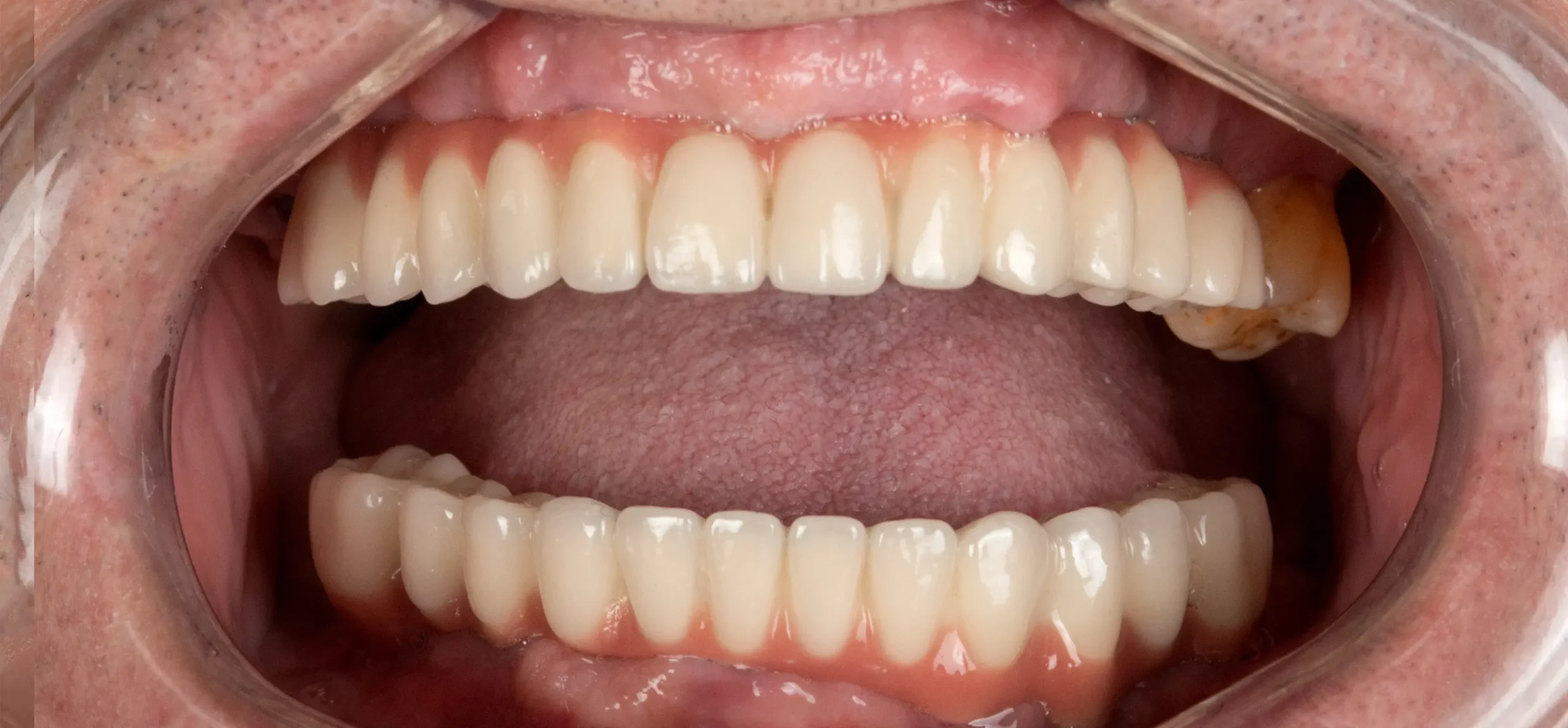 implantodontia-depois