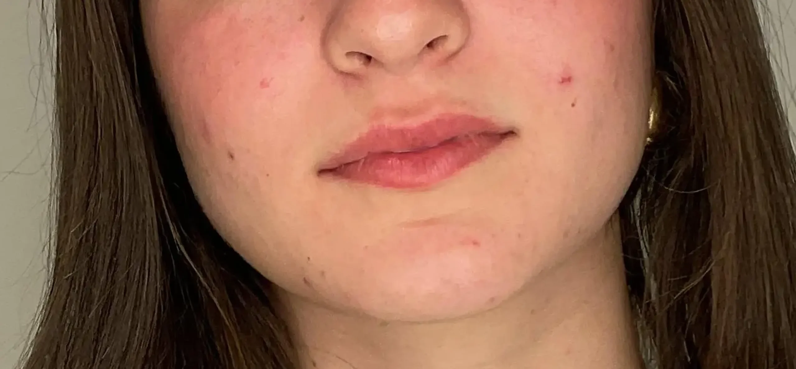 labios-5-antes-botox-harmonizacao-facial-5 labios-5-antes-botox-harmonizacao-facial-5