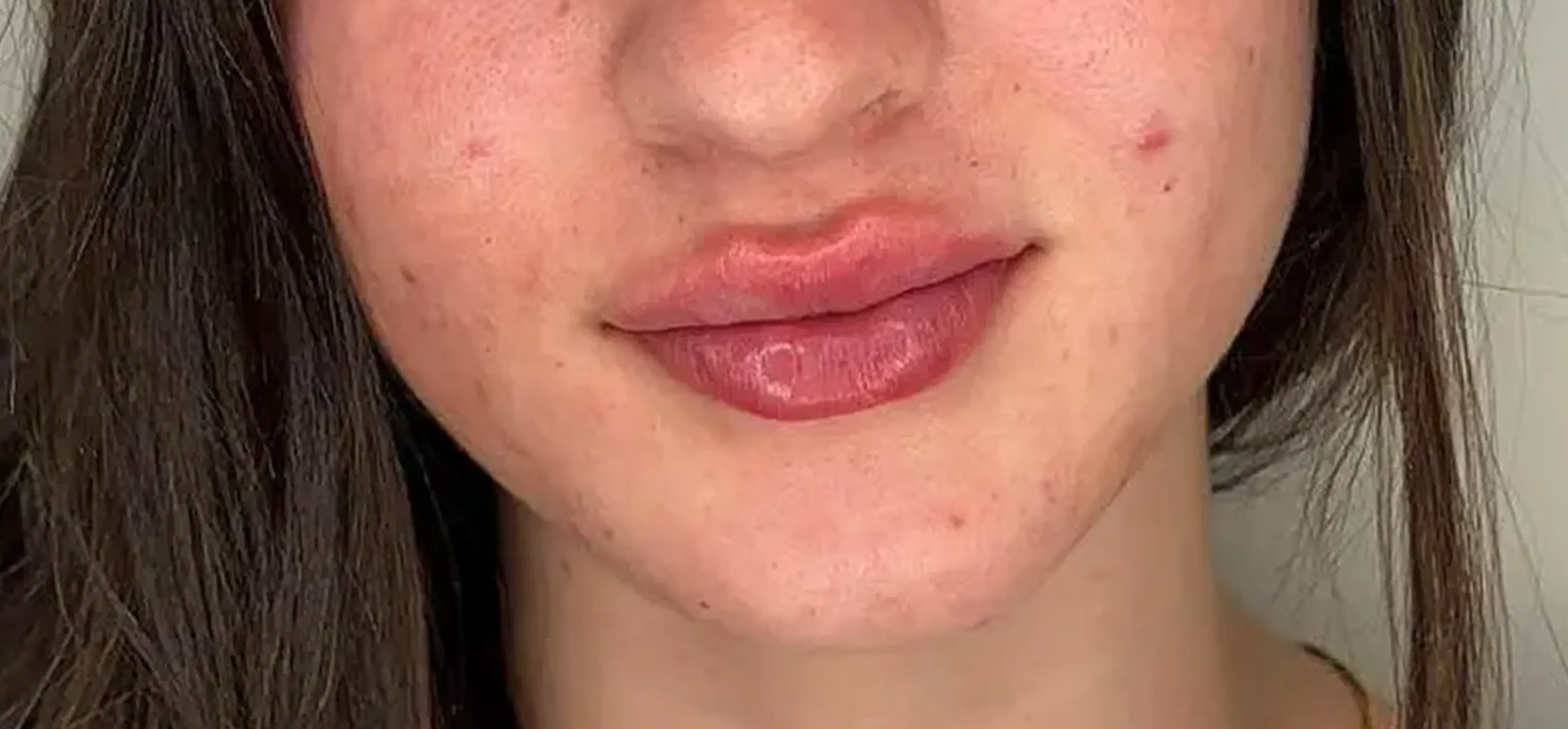 labios-5-depois-botox-harmonizacao-facial-5