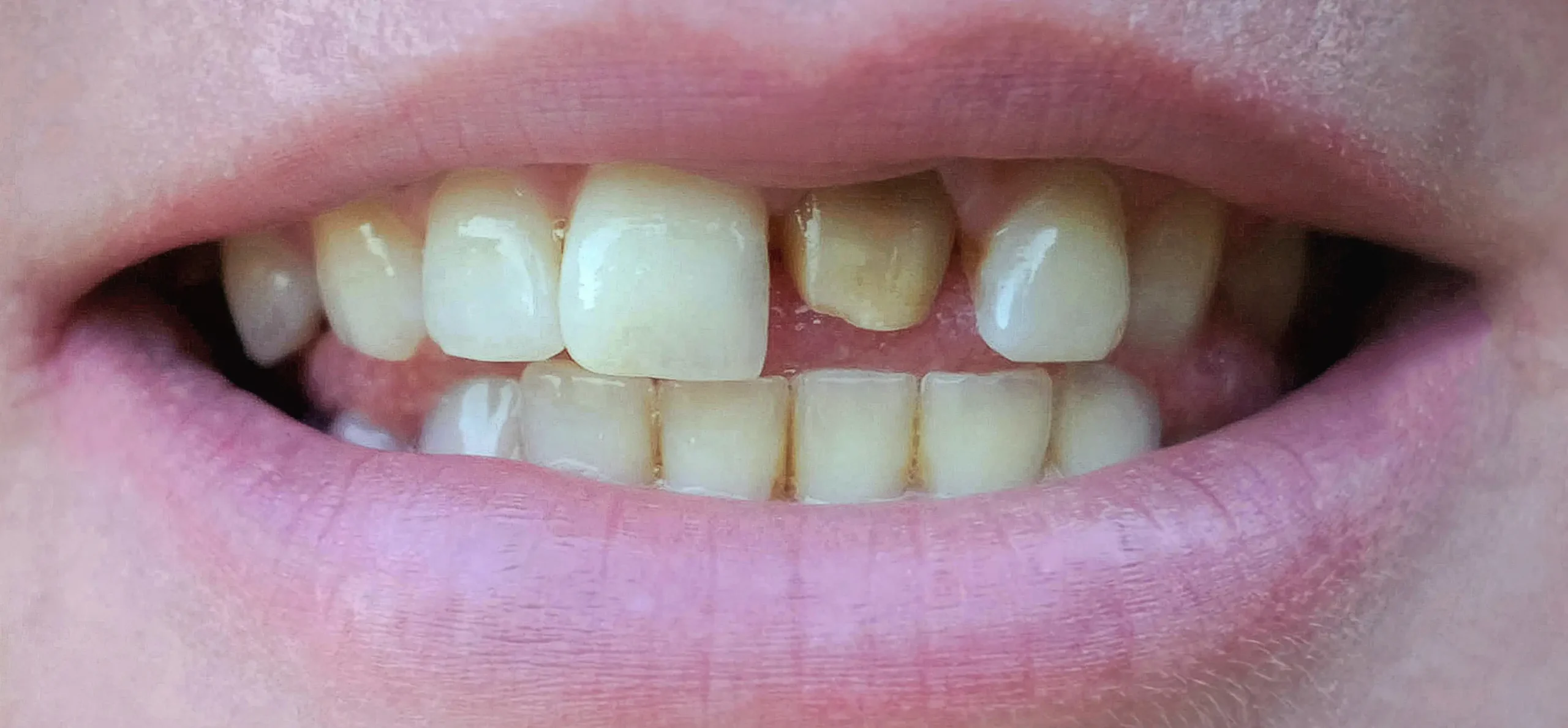 lentes-de-contato-dentais-antes-1 lentes-de-contato-dentais-antes-1