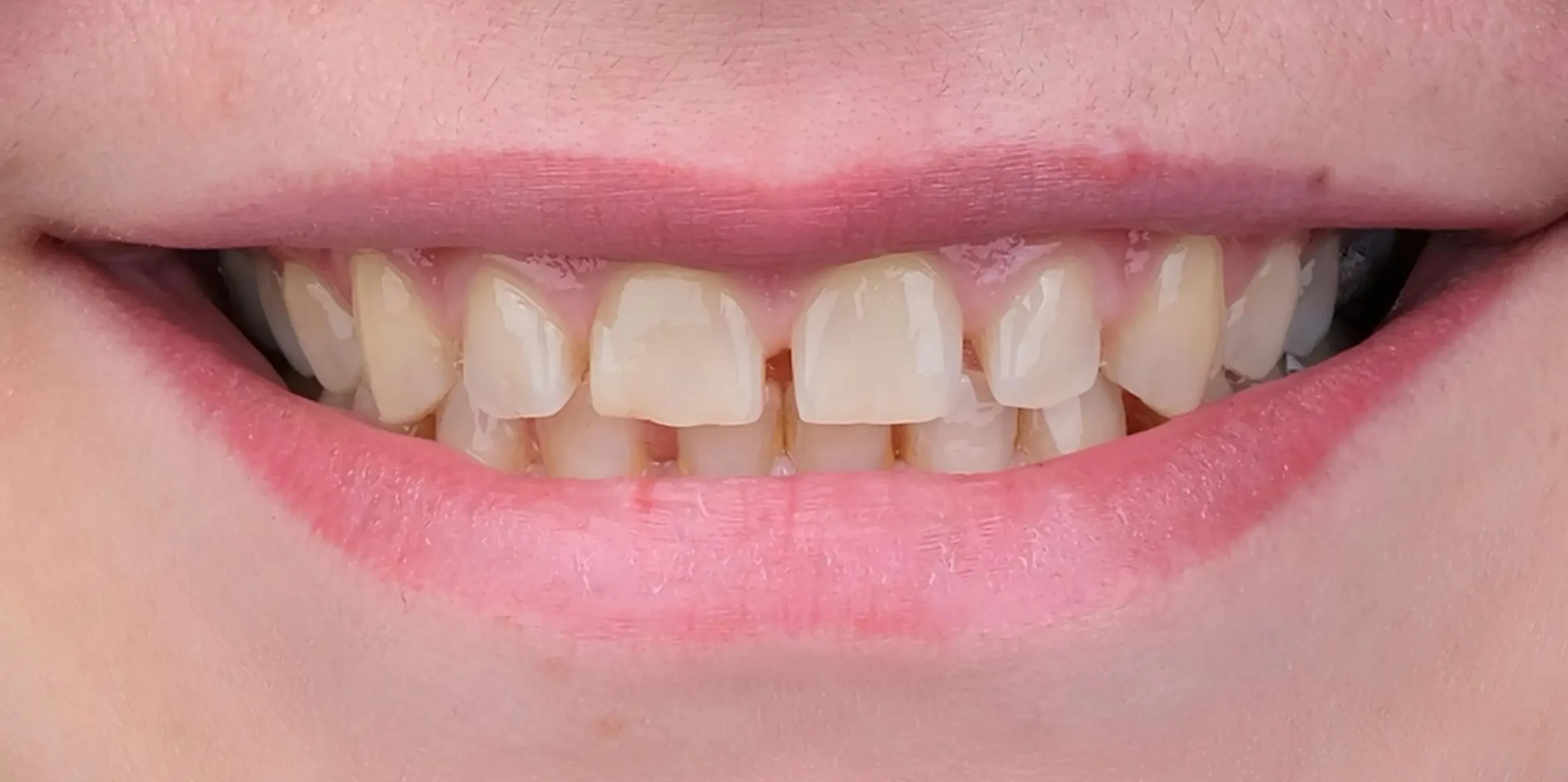 lentes-de-contato-dentais-antes-2 lentes-de-contato-dentais-antes-2