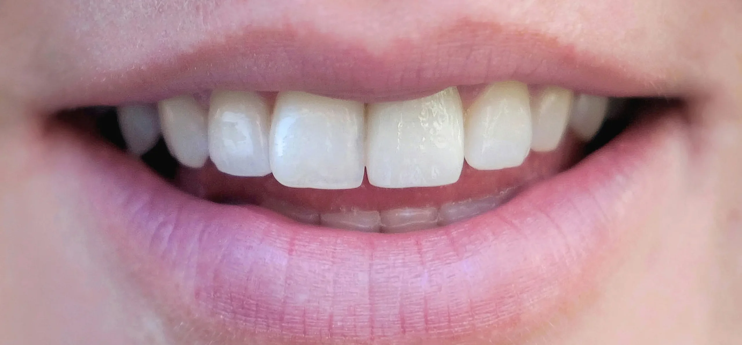 lentes-de-contato-dentais-depois-1