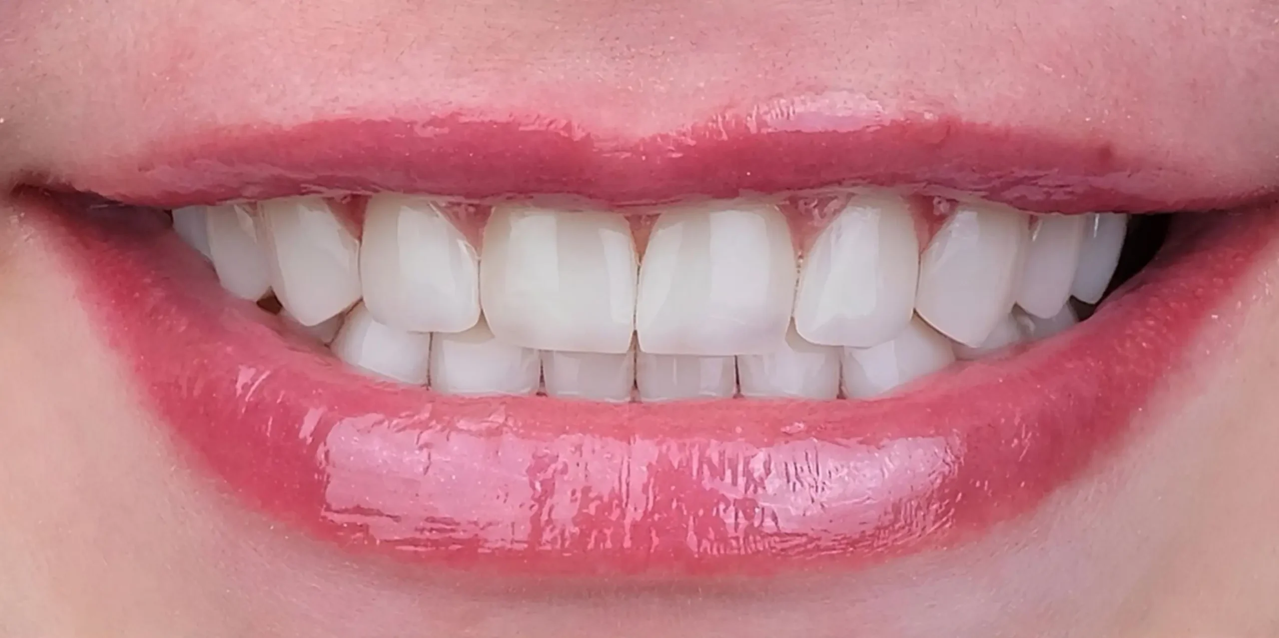 lentes-de-contato-dentais-depois-2