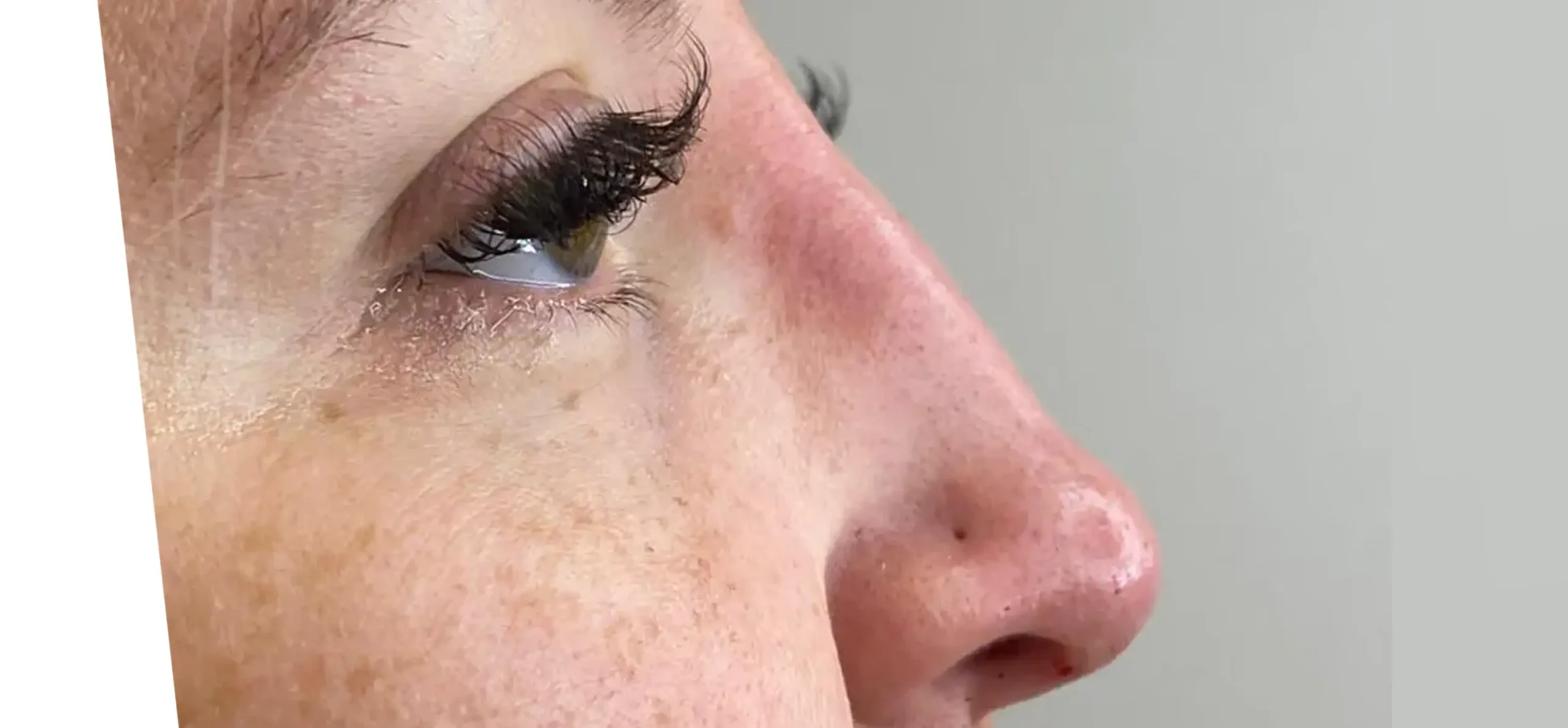 nariz-depois-botox-harmonizacao-facial-1